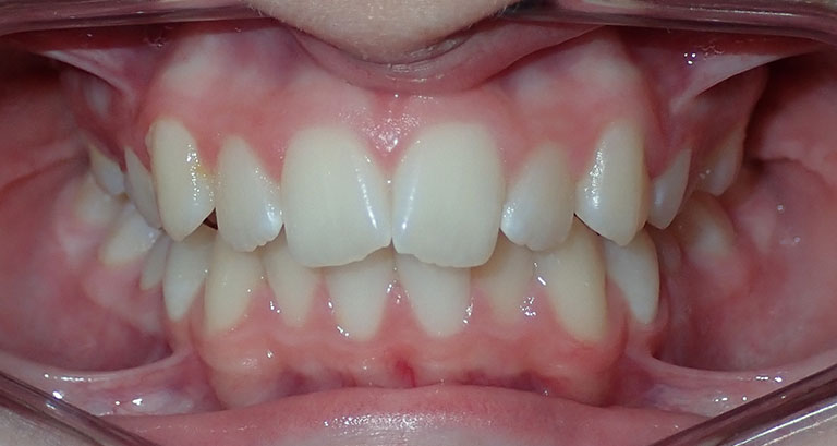 Avery before teeth